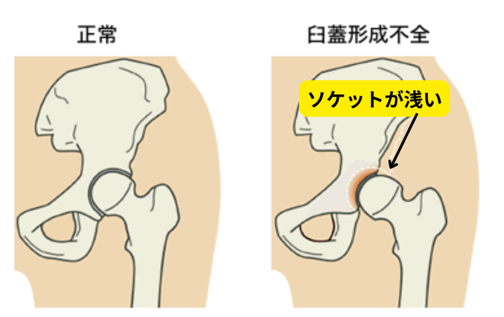 臼蓋形成不全を解説した図